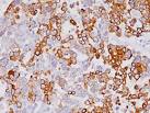 Cytokeratin expression in benign and malignant breast lesions