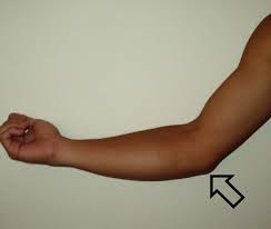 Picture of Ulnar collateral ligament injury