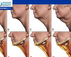 نتائج إبر إذابة الدهون الذقن قبل وبعد الرياض, AI generated
