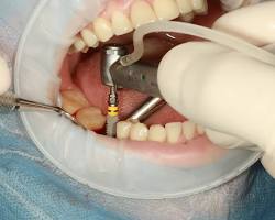 Dental implant removal local anesthesia