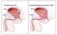 Hypertrophie prostatique adenomateuse