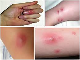 Image result for mrsa infection