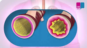 Afbeeldingsresultaat voor astma