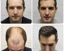 Image of Hair transplant results before and after FUE