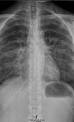 L dme pulmonaire ou de l eau dans les poumons
