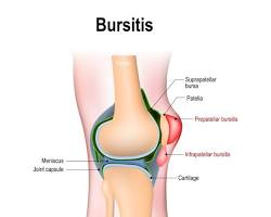 Image of knee bursitis