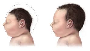 Image result for ZikaVirus