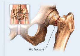 Image result for images osteoporosis