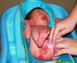 Image result for newborn diaper rash