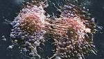 Prostate cancer: Four in 10 cases diagnosed late, charity says