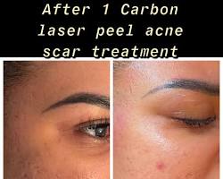 Image of Carbon laser treatment scars