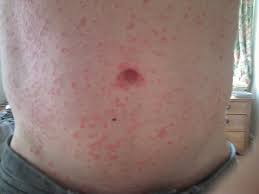 Image result for virus zika