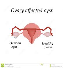 Znalezione obrazy dla zapytania Cysta