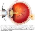 Vitreolysis laser