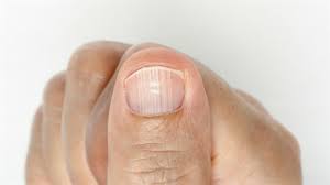 Đốm trắng ở móng tay, nguyên nhân và cách phòng ngừa - Báo ...