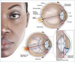 Image result for sakit mata