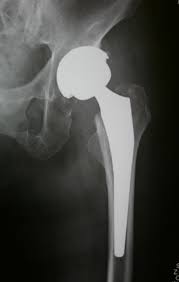 「人工関節 股関節」の画像検索結果