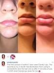 Lip plumper permanent