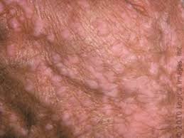 Image result for Lythat gjenitale