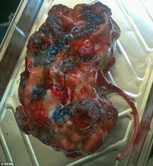 Image result for GINJAL RUSAK