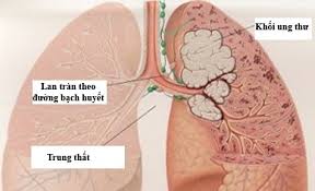 Image result for ung thư
