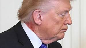 Red Blotch Appears On Trump’s Neck After Hand Bruising