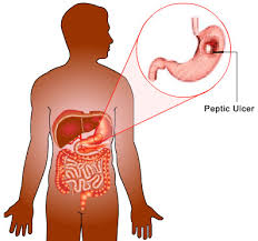 STOMACH ULCER