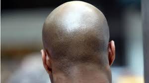 Understanding the Multiple Factors Influencing Baldness Beyond Genetics