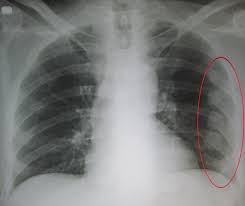 Picture of rib fracture