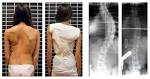 Pose de cheneau scoliosis