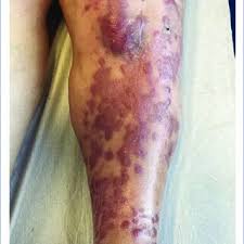 Erythematous-violaceous patches and plaques on the anterior ...