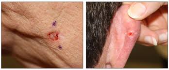 Image result for skin cancer images