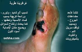 مرض السكري