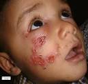 Impetigo chez l enfant