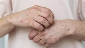 Uruguay se Prepara: Jornada Nacional de Vacunación contra el Sarampión