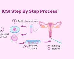 Imagem De Icsi Process