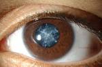 Cataract - , the free encyclopedia