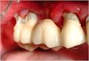 Periodontitt behandling