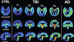  Mental illnesses share genetic similarities