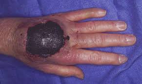 Image result for Necrosis