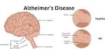 The Aging Brain - Alzheimeraposs Vaccine