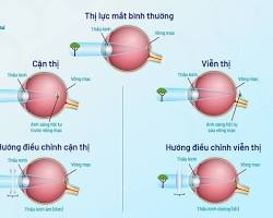 Hình ảnh về Tật khúc xạ mắt