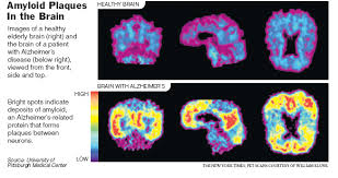 Image result for amyloid plaque