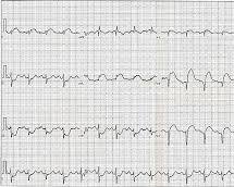 Image of EKG tracing showing ST elevation in a heart attack