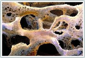 Image result for images osteoporosis