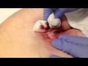 Draining pilonidal cyst