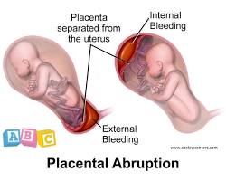 صورة bleeding during labor