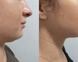 Image of someone with a double chin before and after Kybella treatment
