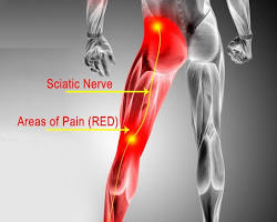 Image of Sciatica pain location