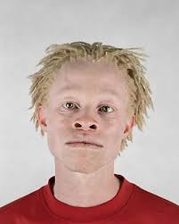 Image result for nigerian albino